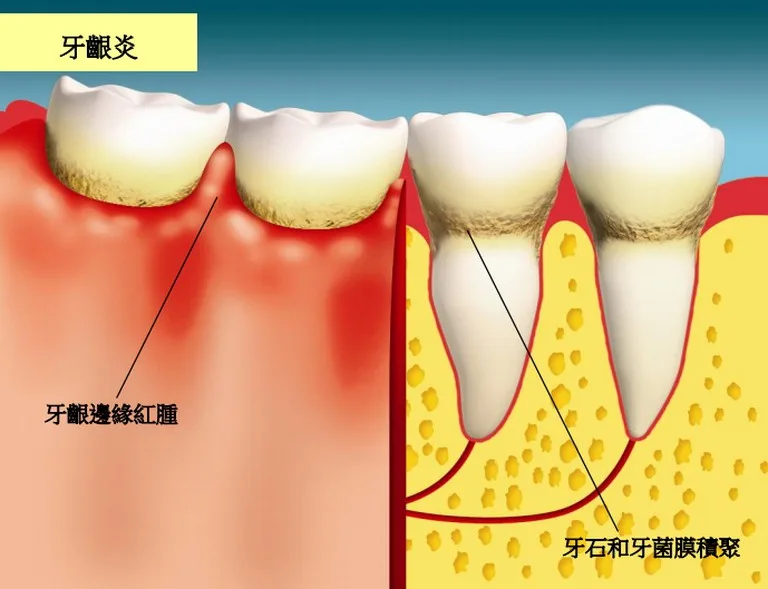 口腔護理 牙齦炎 